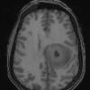 13A2 Abscess (Case 13) T1 - Copy