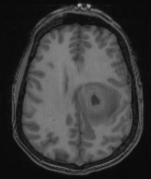 13A2 Abscess (Case 13) T1 - Copy