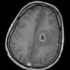 13A3 Abscess (Case 13) T1 W - Copy