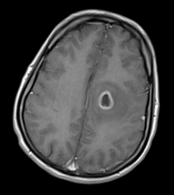 13A3 Abscess (Case 13) T1 W - Copy