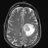 13A4 Abscess (Case 13) T2 (2) - Copy