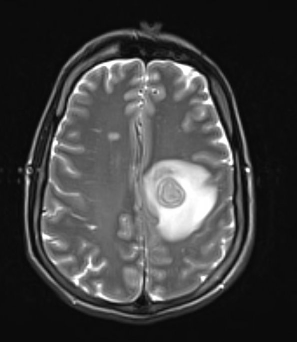 13A4 Abscess (Case 13) T2 (2) - Copy