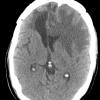 14A1 Abscess, content (Case 14) CT - Copy