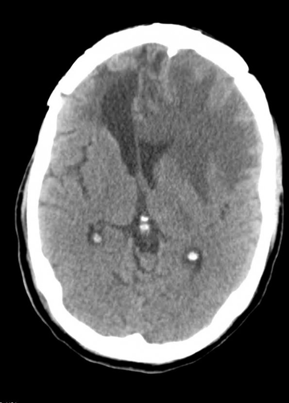 14A1 Abscess, content (Case 14) CT - Copy