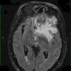 14A2 Abscess, content (Case 14) T2 FLAIR - Copy