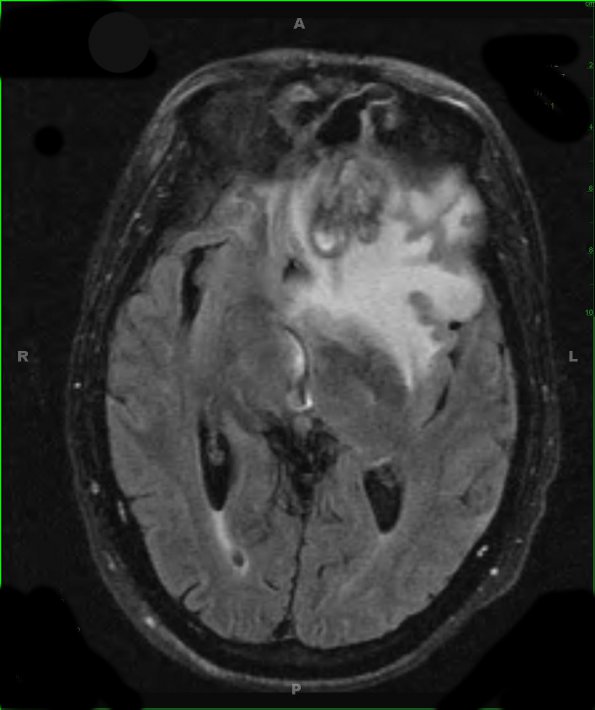 14A2 Abscess, content (Case 14) T2 FLAIR - Copy