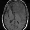 14A3 Abscess, content (Case 14) T1 - Copy