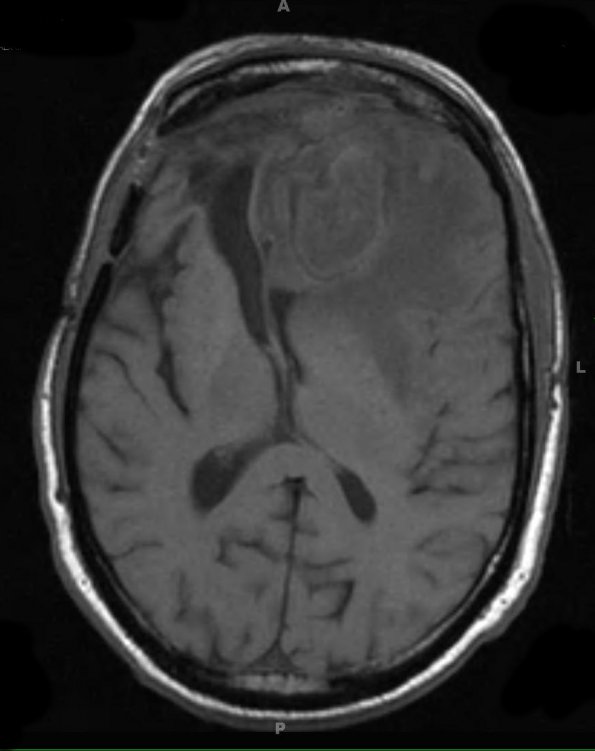 14A3 Abscess, content (Case 14) T1 - Copy