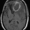 14A4 Abscess, content (Case 14) T1 W 1 - Copy