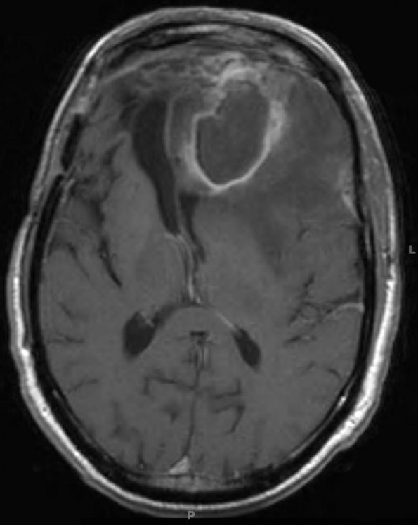 14A4 Abscess, content (Case 14) T1 W 1 - Copy