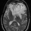 14A5 Abscess, content (Case 14) T2 W - Copy