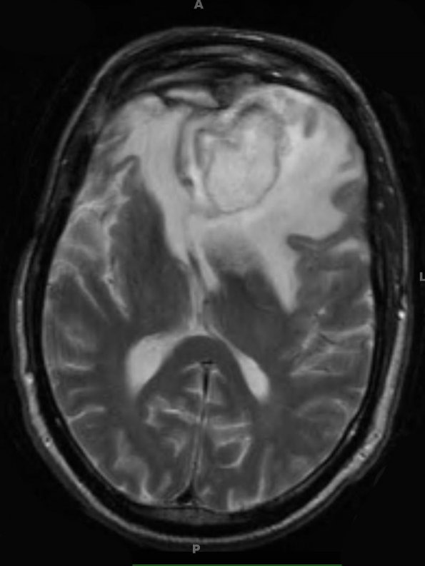 14A5 Abscess, content (Case 14) T2 W - Copy