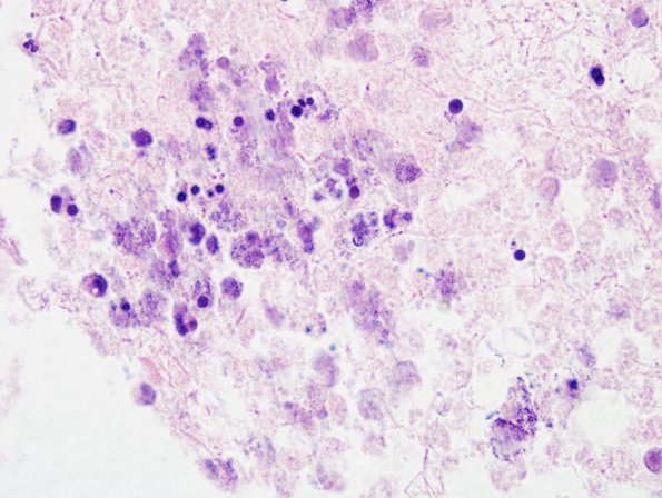 14B2 Abscess, content (Case 14) H&E 2