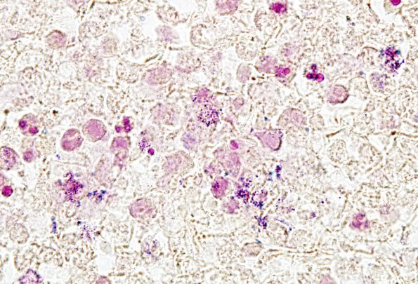 14C Abscess, content (Case 14) Gram 4