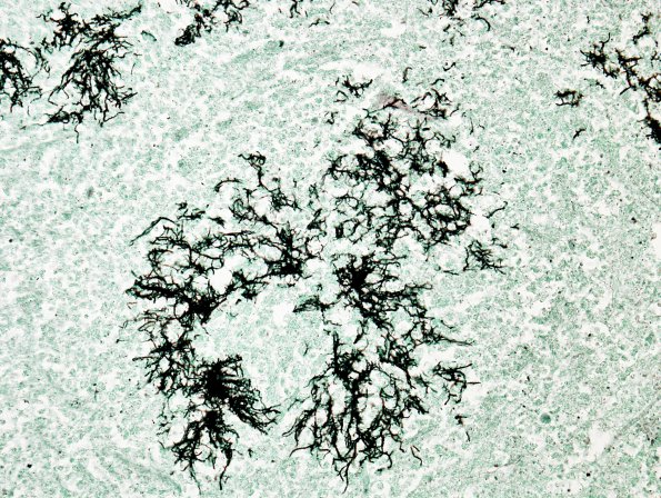 15C3 Actinomycosis (Case 15) GMS 1