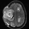 16A1 Abscesses, multiple (Case 15) T2 FLAIR - Copy