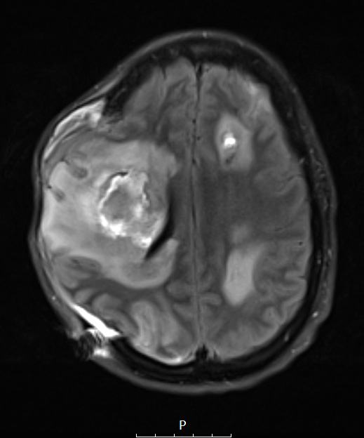 16A1 Abscesses, multiple (Case 15) T2 FLAIR - Copy