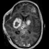 16A2 Abscesses, multiple (Case 15) MPRAGE W - Copy