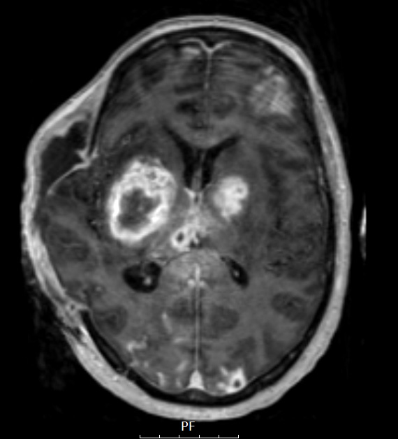 16A2 Abscesses, multiple (Case 15) MPRAGE W - Copy