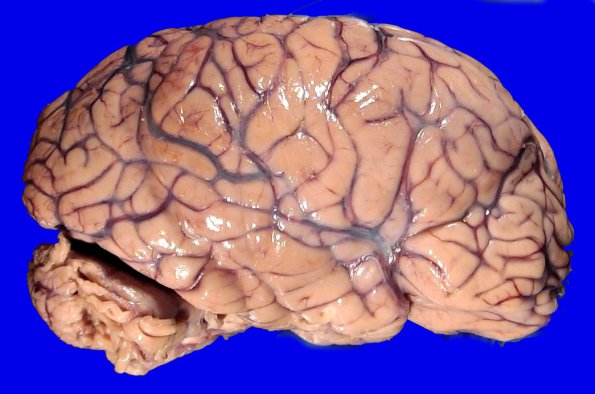 16B1 Abscesses, multiple (Case 15) _1