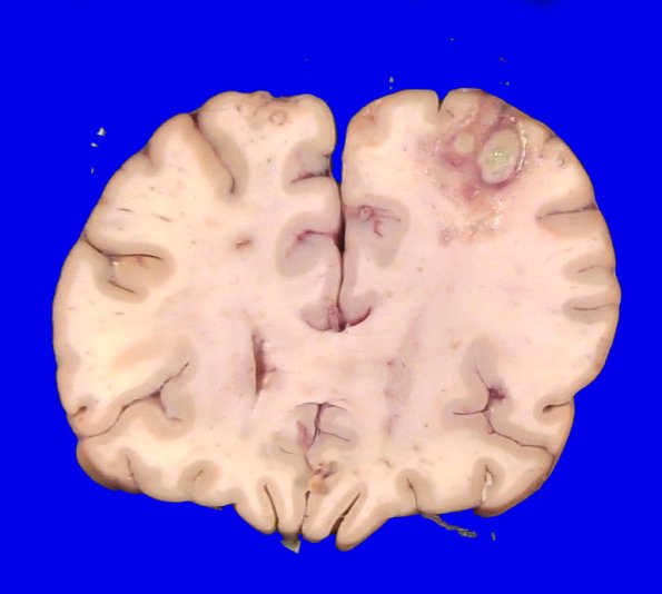 16B2 Abscesses, multiple (Case 15) _5