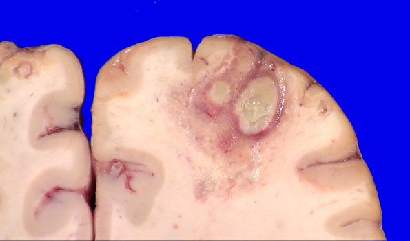 16B3 Abscesses, multiple (Case 15) closeups_2