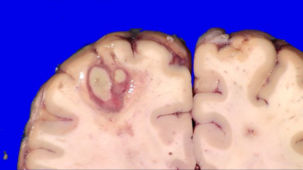 16B4 Abscesses, multiple (Case 15) closeups_3