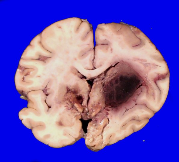 16B5 Abscesses, multiple (Case 15) _2