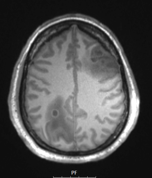 17A3 Abscess B (Case 17) T1noC axial - Copy