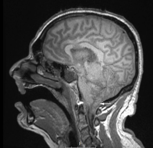 17A5 Abscess B (Case 17) T1noC - Copy copy