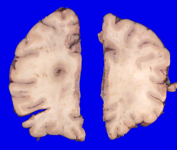 17B2 Abscess (Case 17)_5