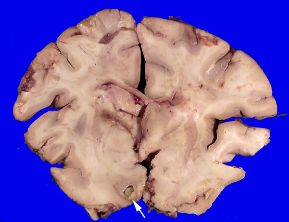17B3 Abscess (Case 17)_8 copy