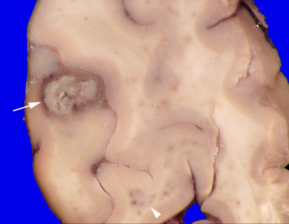 17B5 Abscess (Case 17)_2 copy
