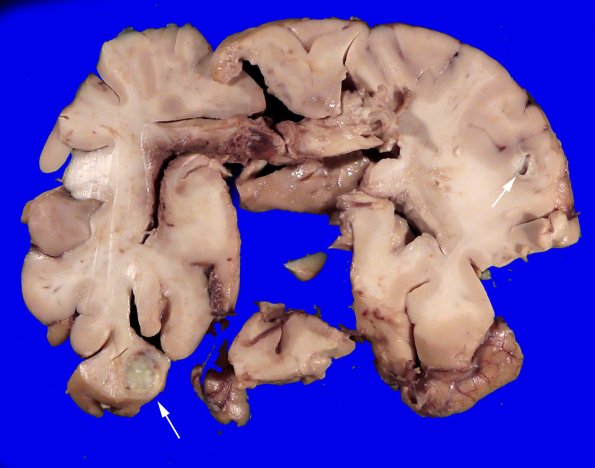17B6 Abscess (Case 17)_11 copy