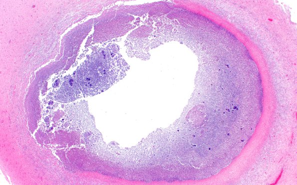 17C11 Abscess (Case 17) N13 H&E 2XA
