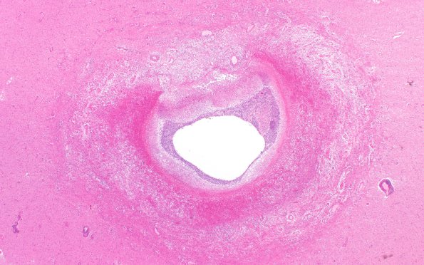 17C12 Abscess (Case 17) N14 H&E 2X