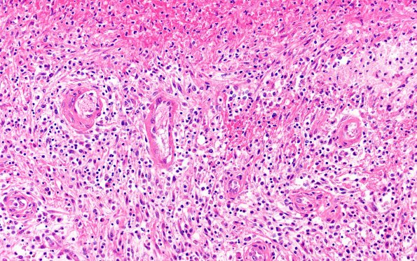 17C6 Abscess (Case 17) N12 H&E 20X