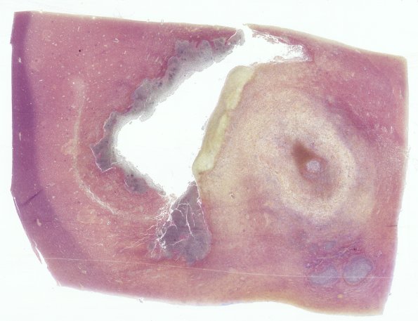 17D1 Abscess (Case 17) N12 Gram WM