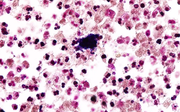 17D2 Abscess (Case 17) N12 Gram 100X 1