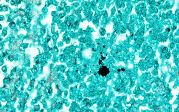 17E1 Abscess (Case 17) N12 GMS 100X 2
