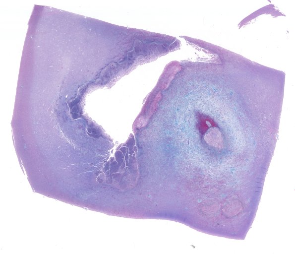 17F1 Abscess (Case 17) N12 TRI WM 2