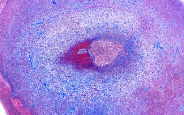 17F2 Abscess A (Case 17) N12 TRI 2XA