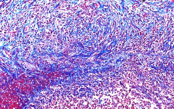 17F3 Abscess A (Case 17) N12 TRI 20X