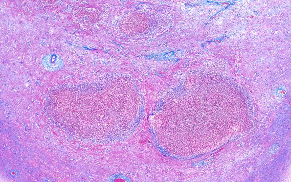 17F5 Abscess B (Case 17) N12 TRI 20X