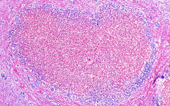 17F6 Abscess B (Case 17) N12 TRI 10X