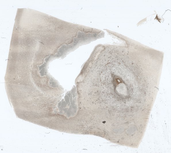 17G1 Abscess (Case 17) N12 Retic WM 2