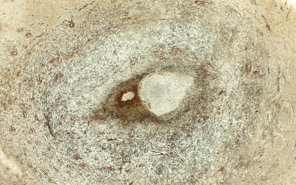 17G2 Abscess A (Case 17) N12 Retic 2XA