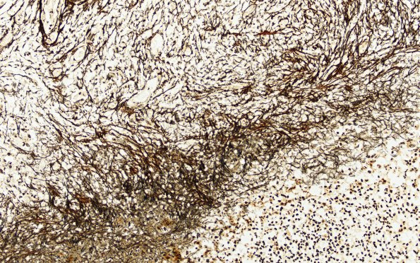 17G3 bscess A (Case 17) N12 Retic 20X