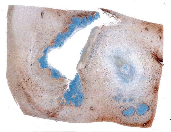 17H1 Abscess (Case 17) N12 GFAP WM 2