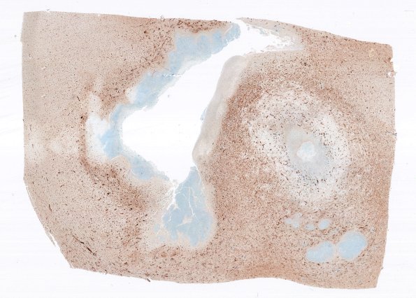 17I1 Abscess (Case 17) N12 CD31 WM 2